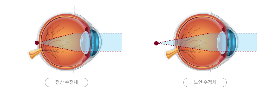 정상 수정체,노안 수정체