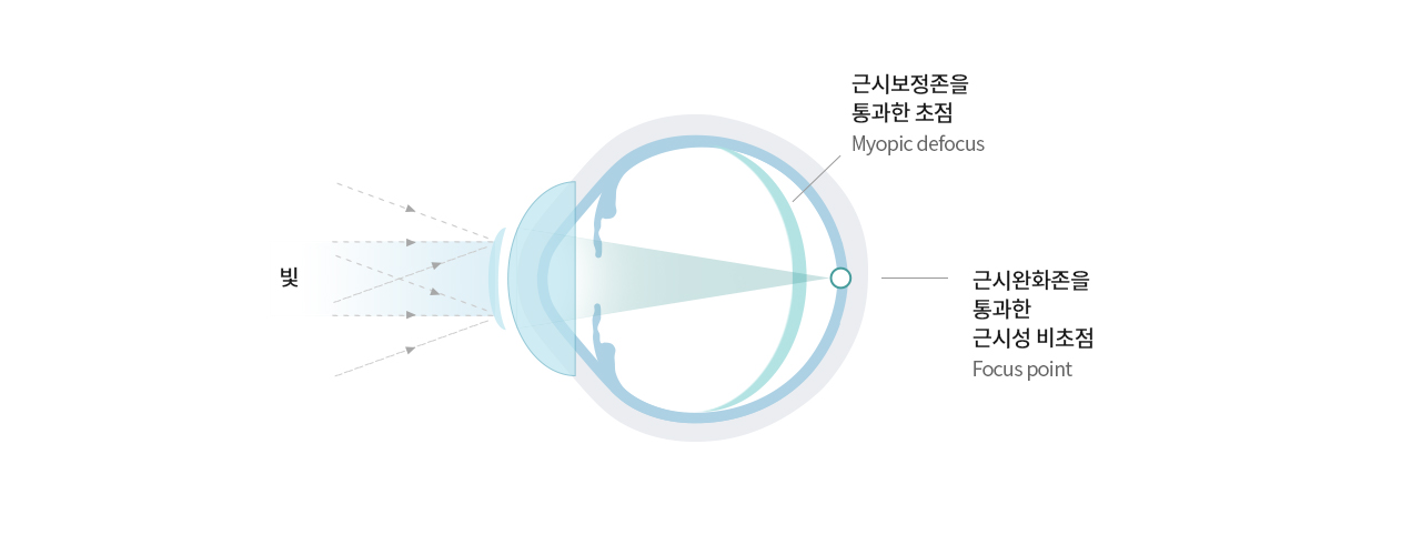 마이사이트 렌즈의 주변부 망막 교정 설계